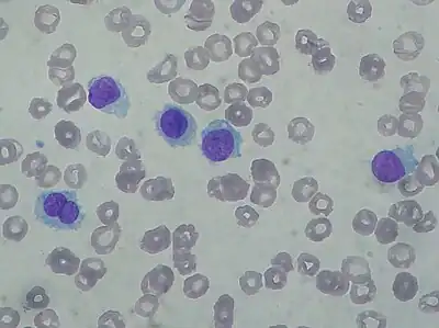 Hairy cell leukemia: Abnormal B cells look "hairy" under a microscope because of radial projections from their surface.