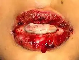 Inflammation and peeling of the lips—with sores presenting on the tongue and the mucous membranes in SJS.