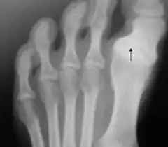 Radiography of the left foot of a young male showing progressive hallux varus