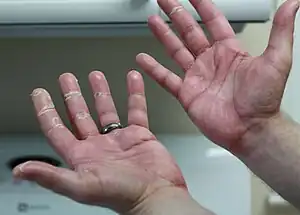 Picture of hands on capecitabine exhibiting signs of chemotherapy-induced acral erythema