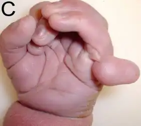 Six fingers in a baby with Patau syndrome