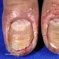 Hand dermatitis