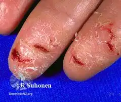 Hand dermatitis