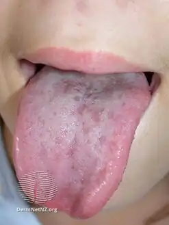 Spots on tongue