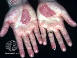 Hands burning after PUVA soaks