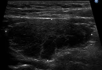 Ultrasound imaging of the thyroid gland (right lobe longitudinal) in a person with Hashimoto thyroiditis.