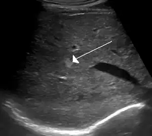 Hemangioma of the liver as seen on ultrasound