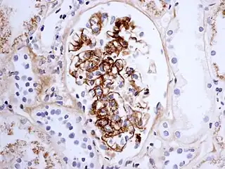 Immunostaining showing IgA in the glomerulus of a patient with Henoch-Schönlein nephritis.