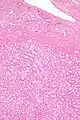 Micrograph of hepatic adenoma. H&E stain