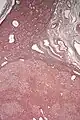 Micrograph of hepatic adenoma. Reticulin stain