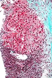 Micrograph of hepatocellular carcinoma. Liver biopsy.