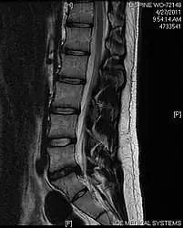 Example of a herniated disc at L5–S1 in the lumbar spine