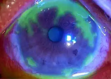 Fluorescein-stained cornea: geographic epithelial defects