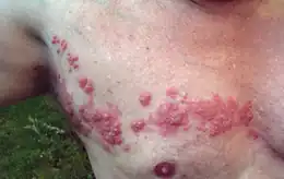 Shingles on the chest