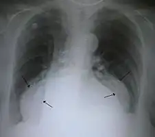 A large hiatal hernia on chest X-ray marked by open arrows in contrast to the heart borders marked by closed arrows