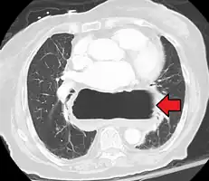 A large hiatal hernia as seen on CT imaging