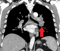 Hilar adenopathy especially on the person's left (coronal CT)