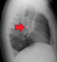 Hilar adenopathy especially on the person's left (lateral CXR)