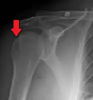 Hill–Sachs lesion post-shoulder dislocation