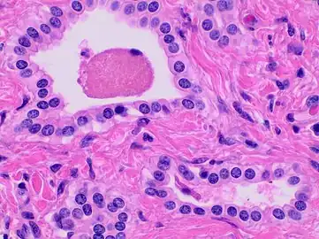 Histopathology of a bile duct hamartoma, high magnification, H&E stain. It shows typical features of bile duct hamartoma: