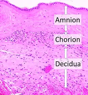 Acute choriodeciduitis, with neutrophils seen in the chorion and decidua.