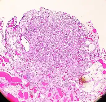 An adenomatoid tumor of the fallopian tube, low magnification, displaying infiltrative-like borders.