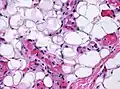 The vessels typically contain hyaline or fibrin (pictured) thrombi
