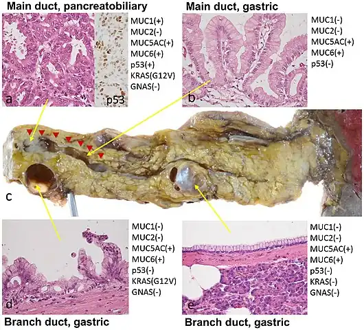 Histopathology of IPMN types in a distal pancreatectomy specimen from a 60-year-old man, by gross pathology (center image), microscopy and immunohistochemistry: The resected specimen (c) revealed that the mural nodule in the MPD consisted of PB-type IPMN with high-grade dysplasia (adenocarcinoma) (a) with a diffuse positivity of p53 immunostaining (an insert) and KRAS mutation (G12V). The BD-IPMN of the body was lined by gastric mucinous epithelium showing low papillary configuration with mild epithelial stratification with the same KRAS mutation (d), and the proliferation of similar gastric IPMN components sequentially involved the bottom of the mural nodule and the wall of the surrounding dilated MPD (indicated by red arrowheads) (b). The BD-IPMN of the tail was lined by flat, monolayer gastric mucinous epithelium lacking cellular atypia and KRAS mutation (e).