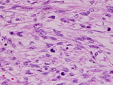 Histopathology of leiomyosarcoma shows variable atypia, often with cytoplasmic vacuoles at both ends of nuclei, and frequent mitoses.