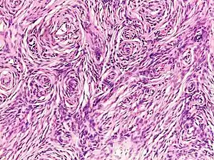 Histopathology of neurofibroma: A spindle cell lesion composed of slender fibroblast-like cells with storiform pattern and very low amount of stroma.