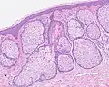 H&E staining of biopsied lesion of sebaceous hyperplasia: Note the multiple, mature sebaceous lobules attached to the central dilated duct in the upper dermis.