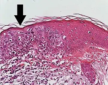 Histopathology of squamous cell carcinoma in situ (black arrow), compared to normal skin, showing marked atypia.