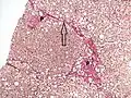 Histopathology of steatohepatitis with moderate fibrosis, with thin fibrous bridges (Van Gieson's stain)