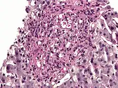 Histoplasma in a granuloma. PAS diastase stain.