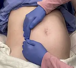 Pulling the uterus off the inferior vena cava