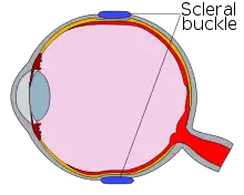 Cross-section diagram of an eye, now showing scleral buckle, in blue, pressing in on the top and bottom of the eye, pressing the choroid lens and the retina together.
