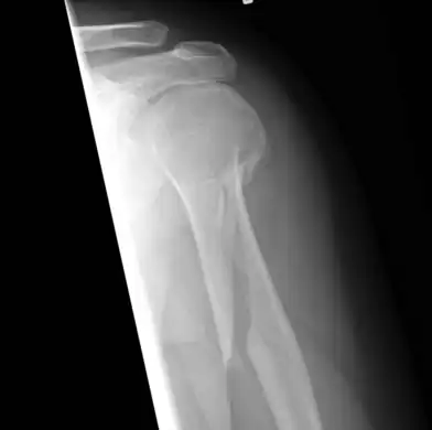 An x-ray image of a spiral fracture to the left humerus of a 27-year-old male. The injury was sustained during a fall.