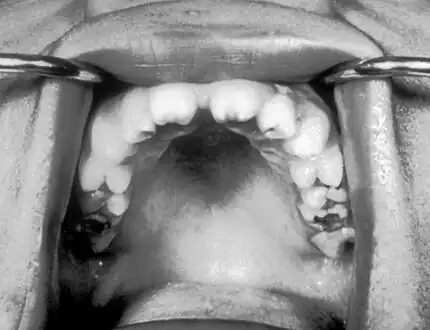 Notched incisors known as Hutchinson's teeth which are characteristic of congenital syphilis