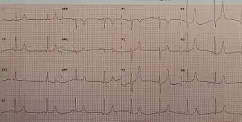 An ECG of a person with a potassium of 5.7 mg/dL showing large T waves and small P waves
