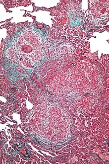 High magnification micrograph of hypersensitivity pneumonitis showing granulomatous inflammation. Trichrome stain.