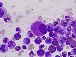 A small, hypolobated megakaryocyte (center of field) in a bone marrow aspirate, characteristic of chronic myeloid leukemia.