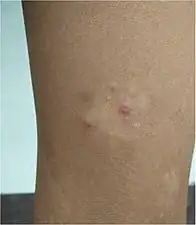 Secondary yaws begin as multiple small lesions