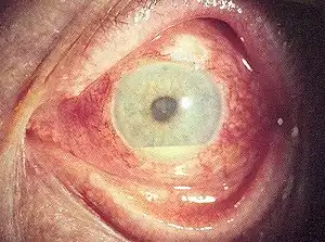 A person with hypopyon which can be seen in anterior uveitis in a person with Behçet's disease