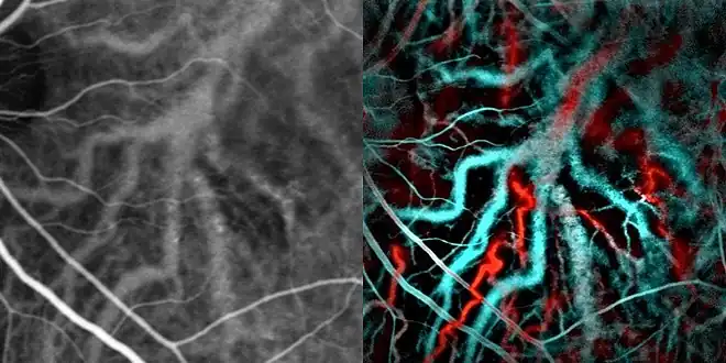 Indocyanine green angiography (left) and laser Doppler imaging (right) of the macula in central serous retinopathy, revealing choroidal vessels. Blue and red correspond ot low and high blood flow respecively.