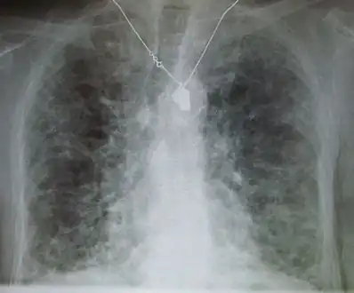 A chest X-ray demonstrating pulmonary fibrosis due to amiodarone