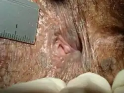 Prior chronic but healed anal fissure