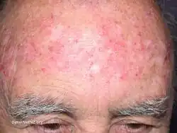 Imiquimod to actinic keratosis