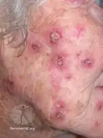 Imiquimod to actinic keratosis