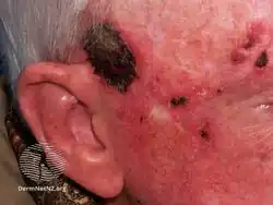 Imiquimod to actinic keratosis