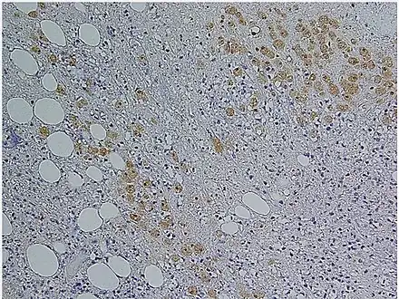 Immunohistochemical staining of trophozoites (brown) using specific anti–Entamoeba histolytica macrophage migration inhibitory factor antibodies in a patient with amebic colitis
